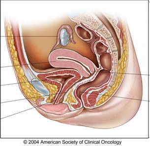 Gynecologic-Cancer