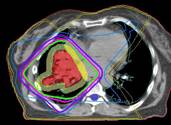 Lung-Cancer