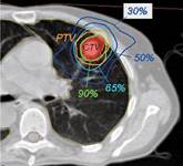 Lung-Cancer