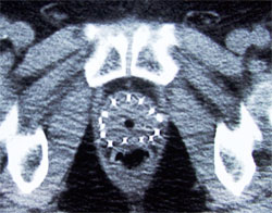 Brachytherapy